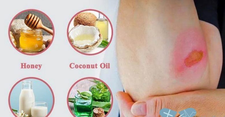 افضل 4+ طرق علاج الحروق بالاعشاب 2025