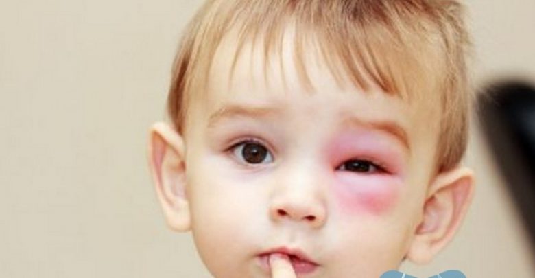 احمرار جفن العين عند الاطفال الرضع | موقع مثقف