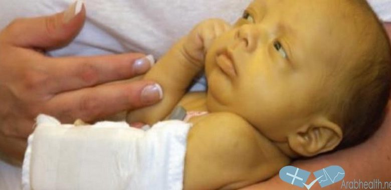 علاج أبو صفار عند حديثي الولادة | موقع مثقف