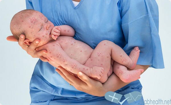 ما الفرق بين الحصبة والحساسية