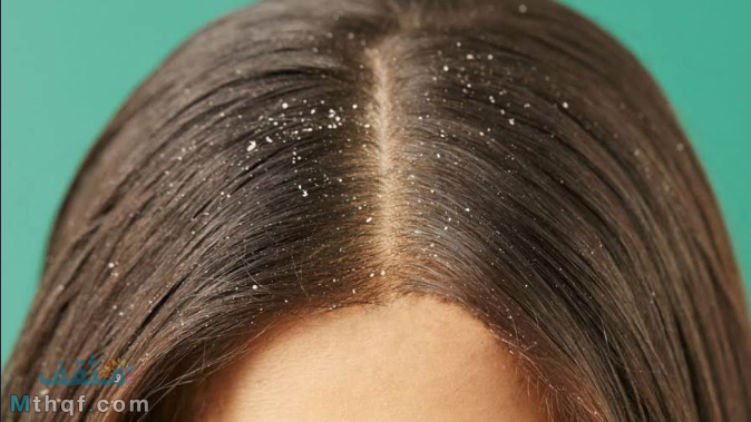 خلطات لعلاج قشرة الشعر