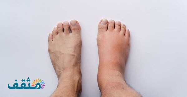 طرق علاج أملاح القدم وأسباب حدوث أنتفاخ للقدمين موقع مثقف